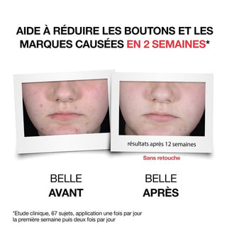 NEUTROGENA ANTI-BOUTONS+ SERUM QUOTIDIEN 30ML