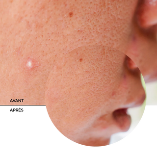 REVOX B77 JUST SUCCINIC ACID SPOT TREATMENT 25 ML